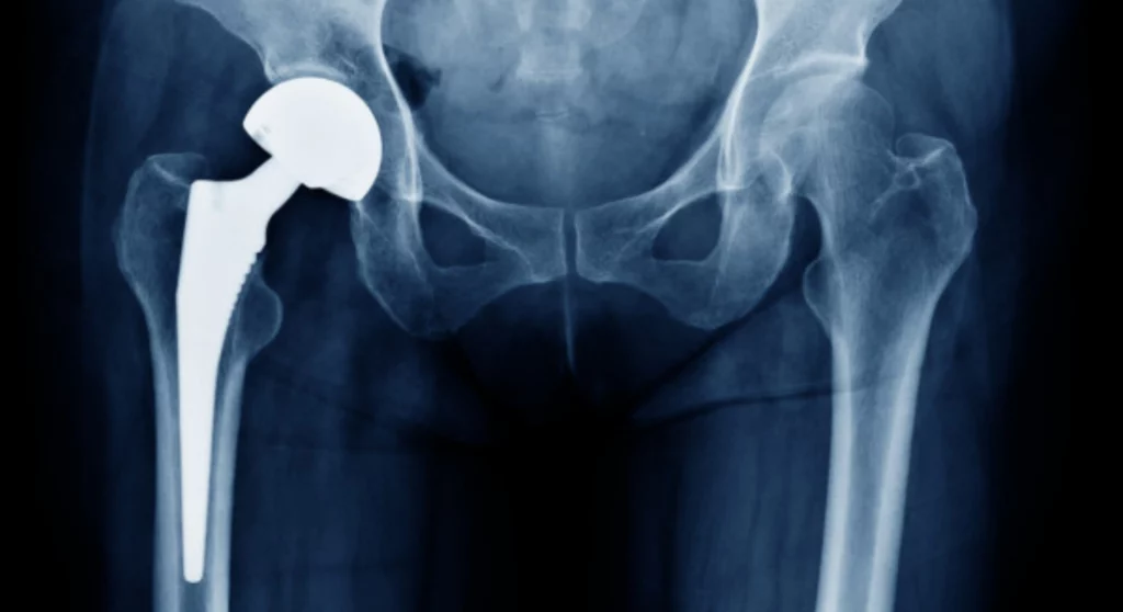 hip replacement